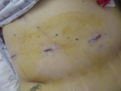 surgery day 035