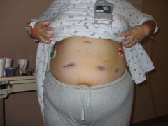 surgery day 040