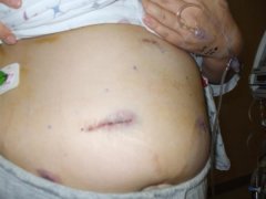 surgery day 041