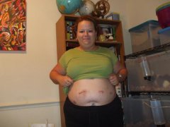 5 days post-op