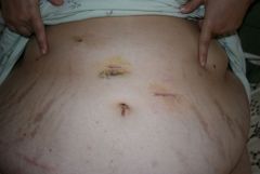2 weeks after surgery