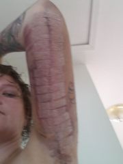 Left Arm 5 Days post Op