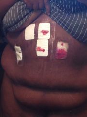 Surgery Day  8/8/13 294 day of surgery