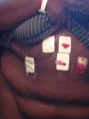 Surgery 8/8/13 294 day of surgery