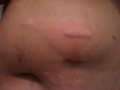 This is when it first started, it was even bigger and redder 4 days later when it was drained.