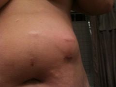 The top scar is my old lap band port scar, the bottom is the new one that's infected, notice the protrusion, ended up being the size of an orange