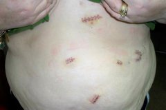 This was taken today....2 days after banding.  Sorry I am still bloated. Gross!!!  Anyway, the top incision is where my port is located.