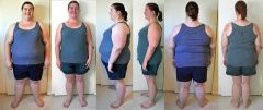 Comparing START to 4 MONTHS post-op, 3 views