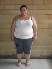 VSG Pic
Taken a few days before Surgery