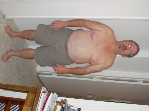 Pre-Surgery