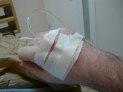 My IV
