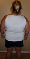 Before surgery back