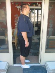 Before Surgery July 2010