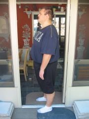 Before Surgery July 2010