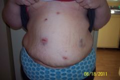 Post surgery owies! August 2011.