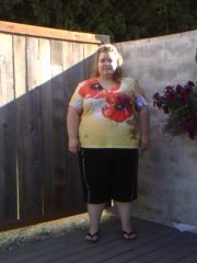 Front shot 3 days Pre Op