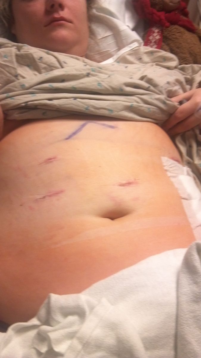 Post-Op