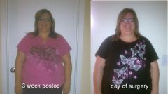 Side by Side Comparison - 3 weeks Post Op Vs. Day Of VSG