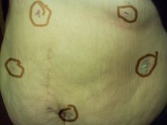 3 weeks post op