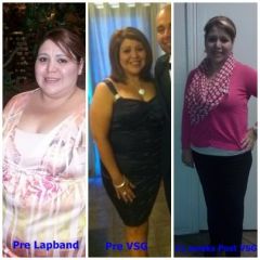 Before Lapband, after VSG, After VSG