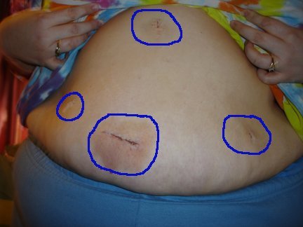Post-Op Pictures.