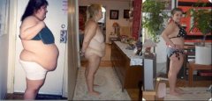 before 330lbsafter -losing 150lbsafter -extended abdominoplasty