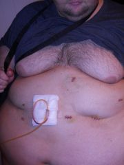 patrickcurl stomach after gastric sleeve Aka frankentummy