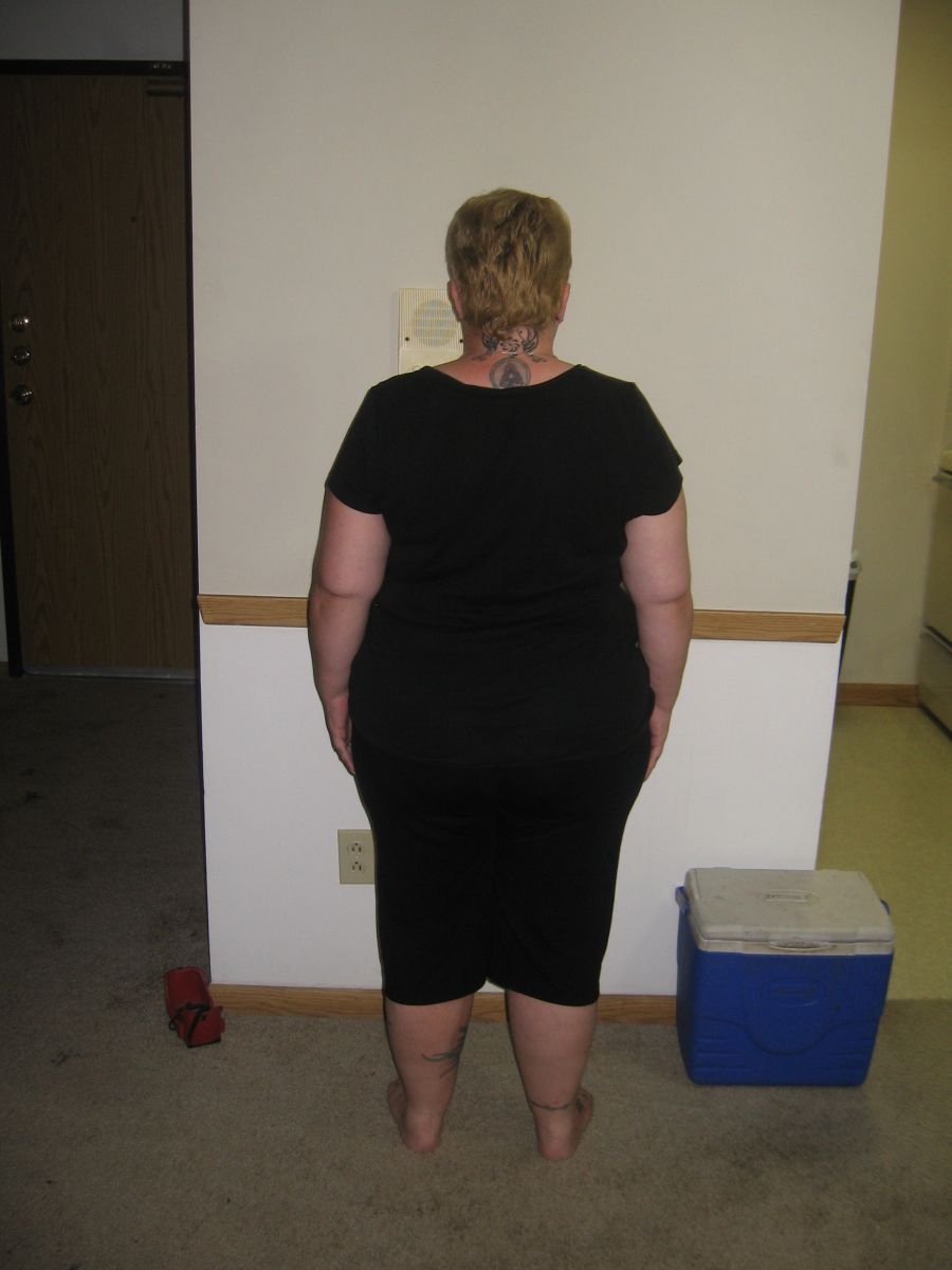 Before Surgery