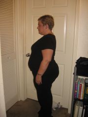 post Op 1 month side