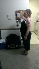 11 month post Op 5 11 13 side