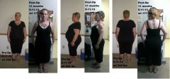 Pre And 11m post Op comparison