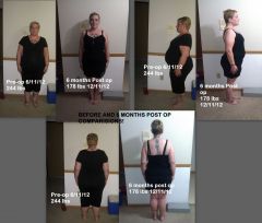 Pre And 6 months post Op comparision