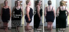 6 month To 11 month post Op comparision