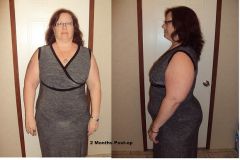 2 months post-op