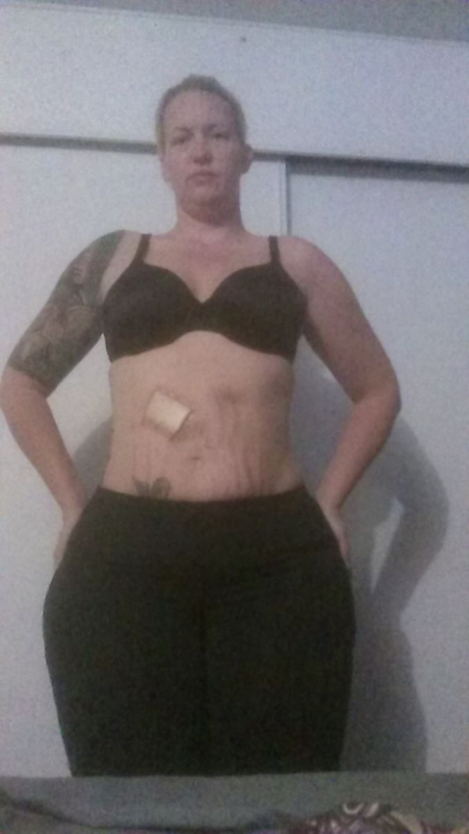 almost 4 weeks after surgery