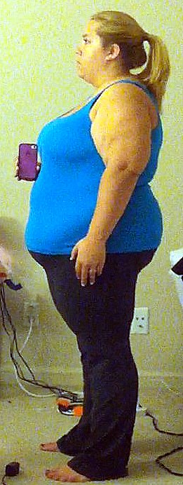 Pre-Op VS. 6 Months Post-Op