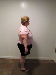 PreOp Right View
