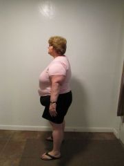PreOp Start Feb 12 left