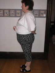 Pre Op Side View