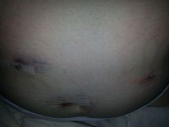 post Op 3
