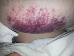 post Op 1