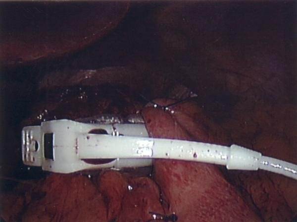 Surgery day