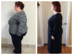 6 months post op, -90 lbs