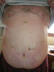 Surgery date Jan 12, 2009. This pic was taken by my dad when he brought me home Jan 14.