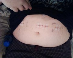 surgery scars