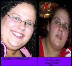 before and 7.5mths postop