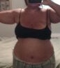 Pre op day 1 july 25th