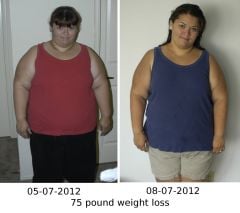 3 month post-op side by ide