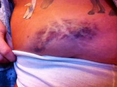 bruising