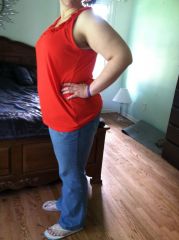 2 mos post-op
